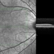 Unilateral Acute Idiopathic Maculopathy - Infrared Photo with OCT through fovea Unilateral Acute Idiopathic Maculopathy - Infrared Photo with OCT through fovea
